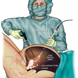 laparoscopy.jpg2