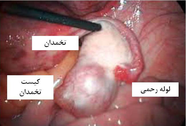 Ovarian-cyst-fig-1