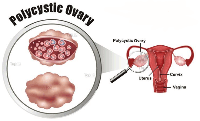 can-i-get-pregnant-with-bilateral-polycystic-ovaries
